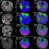 Promising outcomes 5 weeks after a surgical cervical shunting procedure to unclog cerebral lymphatic systems in a patient with Alzheimer’s disease
