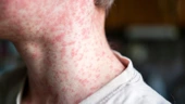 Measles outbreak expands in West Texas around county with low vaccination rate | CNN