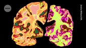 New hope for Alzheimer’s: lithium supplement reverses memory loss in mice