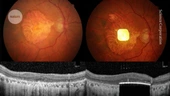 People with blindness can read again after retinal implant