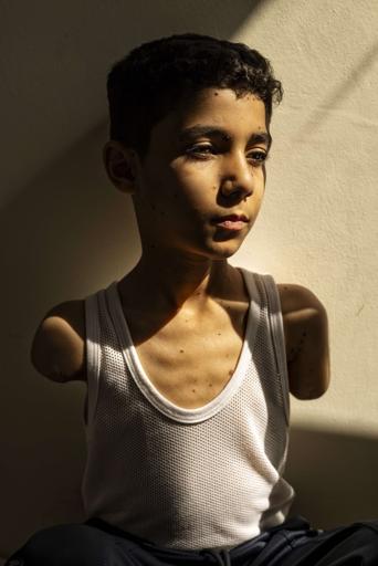Palestinian photojournalist Samar Abu Elouf's award winning portrait of holocaust survivor Mahmoud Ajjour (then 9 years old) from Gaza, mutilated in March 2024 during the ongoing Zionist occupation's barbaric onslaught on the boy's homeland and people.